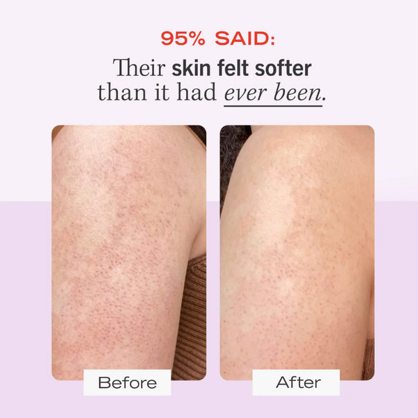 Mini KP Bump Eraser Body Scrub with 10% AHA
